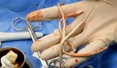 ¿Qué? Tuvieron que operar a joven después de meterse un cable USB por el pene