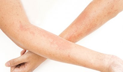 Celulitis infecciosa: ¿qué es y cómo detectarla a tiempo?