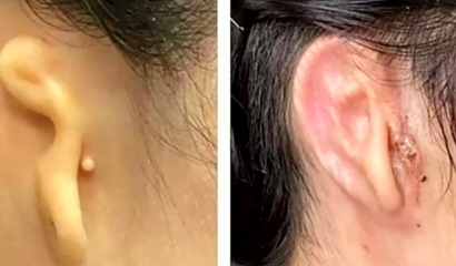 Doctores trasplantan oreja que fue impresa en 3D con las propias células del paciente.